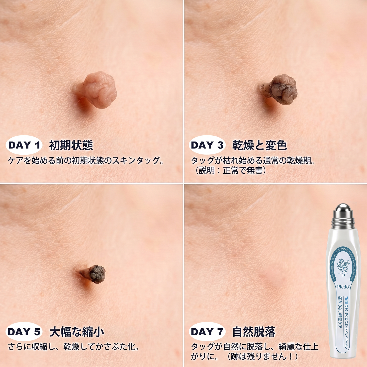 ✅🍋公式ブランドストア  𝐏i𝐜𝐝o® 𝟕日間イボ&シミ消し(痛みも傷跡もゼロのローラーボール)