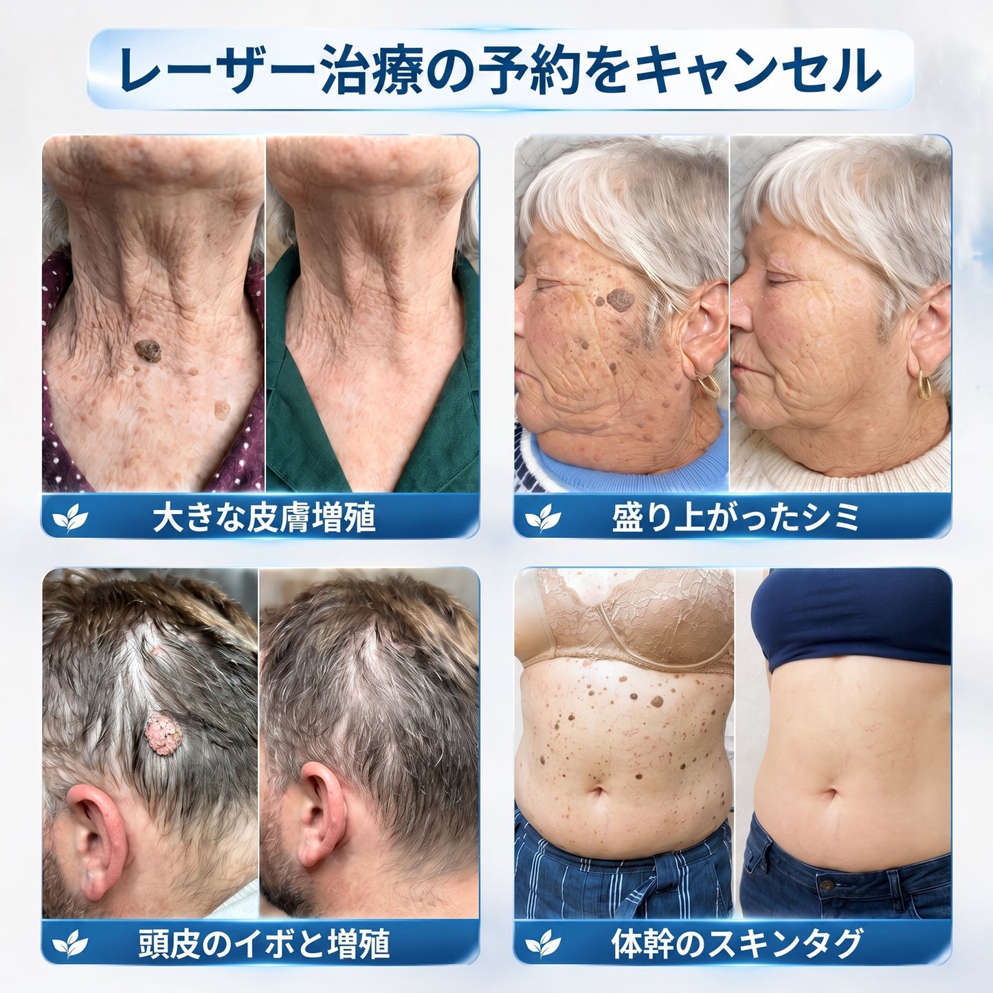✅🍋公式ブランドストア  𝐏i𝐜𝐝o® 𝟕日間イボ&シミ消し(痛みも傷跡もゼロのローラーボール)