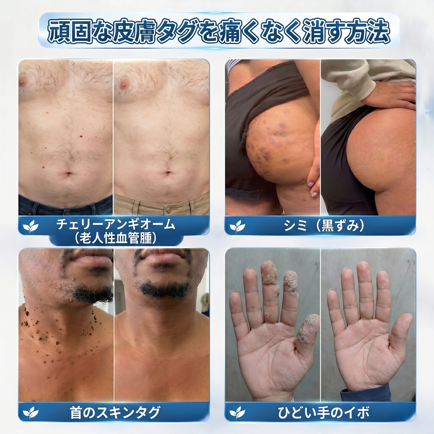 ✅🍋公式ブランドストア  𝐏i𝐜𝐝o® 𝟕日間イボ&シミ消し(痛みも傷跡もゼロのローラーボール)